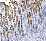 IHC testing of FFPE human colon cancer tissue with Mucin-2 antibody at 1ug/ml. Required HIER: steam section in pH8 EDTA for 20 min and allow to cool prior to testing.