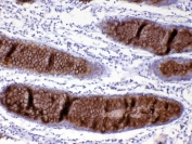 IHC testing of FFPE human rectal cancer tissue with Mucin-2 antibody at 1ug/ml. Required HIER: steam section in pH6 citrate buffer for 20 min and allow to cool prior to testing.