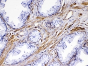 IHC testing of FFPE human prostate cancer tissue with VEGF Receptor 3 antibody at 1ug/ml. Required HIER: steam section in pH6 citrate buffer for 20 min and allow to cool prior to testing.