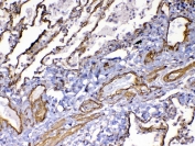 IHC testing of FFPE human lung cancer tissue with VEGF Receptor 3 antibody at 1ug/ml. Required HIER: steam section in pH6 citrate buffer for 20 min and allow to cool prior to testing.