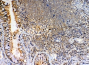 IHC staining of FFPE human lung cancer with GRK2 antibody. HIER: boil tissue sections in pH6, 10mM citrate buffer, for 20 min and allow to cool before testing.