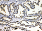 IHC testing of FFPE human lung cancer tissue with SOD3 antibody at 1ug/ml. Required HIER: steam section in pH6 citrate buffer for 20 min and allow to cool prior to testing.