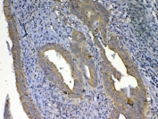 IHC testing of FFPE human rectal cancer tissue with UGT1A1 antibody at 1ug/ml. Required HIER: steam section in pH6 citrate buffer for 20 min and allow to cool prior to testing.