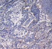 IHC testing of FFPE human lung cancer tissue with ITGA5 antibody at 1ug/ml. Required HIER: steam section in pH6 citrate buffer for 20 min and allow to cool prior to testing.