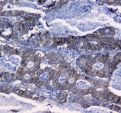IHC testing of FFPE human colon cancer tissue with ITGA5 antibody at 1ug/ml. Required HIER: steam section in pH6 citrate buffer for 20 min and allow to cool prior to testing.