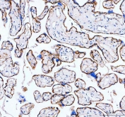 IHC testing of FFPE human colon cancer tissue with ITGA5 antibody at 1ug/ml. Required HIER: steam section in pH6 citrate buffer for 20 min and allow to cool prior to testing.