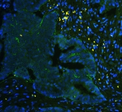 Immunofluorescent staining of FFPE human colon cancer with ITGA5 antibody (green) and DAPI nuclear stain (blue). HIER: boil tissue sections in pH6, 10mM citrate buffer, for 10-20 min and allow to cool before testing.