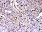 IHC testing of FFPE human lung cancer tissue with FZD4 antibody at 1ug/ml. Required HIER: steam section in pH6 citrate buffer for 20 min and allow to cool prior to testing.
