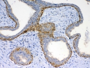 IHC testing of FFPE human breast cancer tissue with FZD4 antibody at 1ug/ml. Required HIER: steam section in pH6 citrate buffer for 20 min and allow to cool prior to testing.