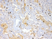 IHC testing of FFPE human lung cancer tissue with Psoriasin antibody at 1ug/ml. Required HIER: steam section in pH6 citrate buffer for 20 min and allow to cool prior to testing.