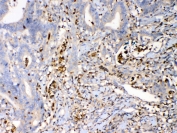 IHC testing of FFPE human rectal cancer tissue with Psoriasin antibody at 1ug/ml. Required HIER: steam section in pH6 citrate buffer for 20 min and allow to cool prior to testing.