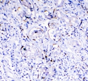 IHC testing of FFPE human lung cancer with TL1A antibody. HIER: boil tissue sections in pH6, 10mM citrate buffer, for 10-20 min followed by cooling at RT for 20 min.
