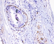 IHC testing of FFPE human lung cancer with TL1A antibody. HIER: boil tissue sections in pH6, 10mM citrate buffer, for 10-20 min followed by cooling at RT for 20 min.