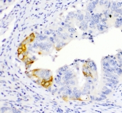 IHC testing of FFPE human intestinal cancer with TL1A antibody. HIER: boil tissue sections in pH6, 10mM citrate buffer, for 10-20 min followed by cooling at RT for 20 min.
