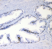 IHC testing of FFPE human prostate cancer with TL1A antibody. HIER: boil tissue sections in pH6, 10mM citrate buffer, for 10-20 min followed by cooling at RT for 20 min.