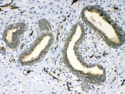 IHC testing of FFPE human breast cancer tissue with PPID antibody at 1ug/ml. Required HIER: steam section in pH6 citrate buffer for 20 min and allow to cool prior to testing.