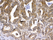 IHC testing of FFPE human rectal cancer tissue with PPID antibody at 1ug/ml. Required HIER: steam section in pH6 citrate buffer for 20 min and allow to cool prior to testing.