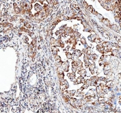 IHC staining of FFPE human lung adenocarcinoma tissue with CDH5 antibody. HIER: boil tissue sections in pH8 EDTA for 20 min and allow to cool before testing.