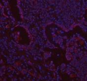 Immunofluorescent staining of FFPE human lung cancer tissue with CDH5 antibody (red) and DAPI nuclear stain (blue). HIER: steam section in pH8 EDTA buffer for 20 min.