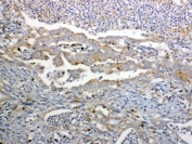 IHC testing of FFPE human colon cancer tissue with GALNS antibody at 1ug/ml. Required HIER: steam section in pH6 citrate buffer for 20 min and allow to cool prior to testing.