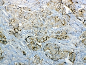 IHC testing of FFPE human breast cancer tissue with GALNS antibody at 1ug/ml. Required HIER: steam section in pH6 citrate buffer for 20 min and allow to cool prior to testing.