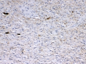 IHC testing of FFPE human glioma with GAD65 antibody at 1ug/ml. Required HIER: steam section in pH6 citrate buffer for 20 min and allow to cool prior to testing.