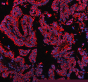 Immunofluorescent staining of FFPE human lung cancer tissue with PDK2 antibody (red) and DAPI nuclear stain (blue). HIER: steam section in pH8 EDTA buffer for 20 min.