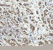 IHC staining of FFPE human breast cancer tissue with PDK2 antibody, HRP-secondary and DAB substrate. HIER: boil tissue sections in pH8 EDTA for 20 min and allow to cool before testing.