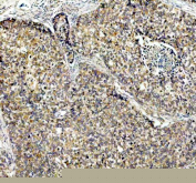 IHC staining of FFPE human lung cancer tissue with PDK2 antibody, HRP-secondary and DAB substrate. HIER: boil tissue sections in pH8 EDTA for 20 min and allow to cool before testing.