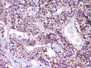 IHC testing of FFPE human lung cancer tissue with CXCL14 antibody at 1ug/ml. Required HIER: steam section in pH6 citrate buffer for 20 min and allow to cool prior to testing.