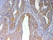 IHC testing of FFPE human rectal cancer tissue with CXCL14 antibody at 1ug/ml. Required HIER: steam section in pH6 citrate buffer for 20 min and allow to cool prior to testing.
