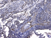 IHC testing of FFPE human lung cancer tissue with GSTM3 antibody at 1ug/ml. Required HIER: steam section in pH6 citrate buffer for 20 min and allow to cool prior to testing.