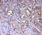 IHC staining of FFPE human breast cancer with IQGAP2 antibody. HIER: boil tissue sections in pH8 EDTA for 20 min and allow to cool before testing.