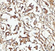 IHC testing of FFPE human breast cancer tissue with CP110 antibody. Required HIER: steam section in pH8 EDTA buffer for 20 min and allow to cool prior to testing.
