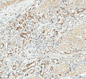 IHC testing of FFPE human colorectal adenocarcinoma tissue with CP110 antibody. Required HIER: steam section in pH8 EDTA buffer for 20 min and allow to cool prior to testing.