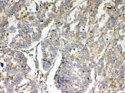 IHC testing of FFPE human lung cancer tissue with TSPAN12 antibody at 1ug/ml. Required HIER: steam section in pH6 citrate buffer for 20 min and allow to cool prior to testing.