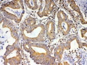 IHC testing of FFPE human rectal cancer tissue with TSPAN12 antibody at 1ug/ml. Required HIER: steam section in pH6 citrate buffer for 20 min and allow to cool prior to testing.