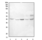 IHC testing of FFPE human rectal cancer tissue with TSPAN12 antibody at 1ug/ml. Required HIER: steam section in pH6 citrate buffer for 20 min and allow to cool prior to testing.