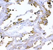 IHC staining of FFPE human lung cancer tissue with DYNLT1 antibody. HIER: boil tissue sections in pH8 EDTA for 20 min and allow to cool before testing.