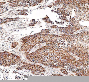 Immunohistochemical staining of FFPE human esophageal keratinizing squamous cell carcinoma tissue with DYNLT1 antibody, HRP-secondary and DAB substrate. HIER: boil tissue sections in pH8 EDTA for 20 min and allow to cool before testing.