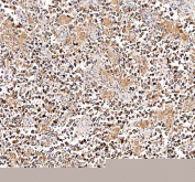 Immunohistochemical staining of FFPE human testis cancer tissue with DYNLT1 antibody, HRP-secondary and DAB substrate. HIER: boil tissue sections in pH8 EDTA for 20 min and allow to cool before testing.
