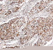 Immunohistochemical staining of FFPE human lung cancer tissue with DYNLT1 antibody, HRP-secondary and DAB substrate. HIER: boil tissue sections in pH8 EDTA for 20 min and allow to cool before testing.
