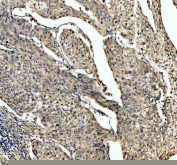 IHC staining of FFPE human cervical cancer tissue with SKP2 antibody, HRP-labeled secondary and DAB substrate. HIER: boil tissue sections in pH8 EDTA for 20 min and allow to cool before testing.