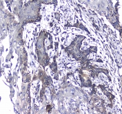 IHC testing of FFPE human glioma with L1CAM antibody at 1ug/ml. Required HIER: steam section in pH6 citrate buffer for 20 min and allow to cool prior to staining.
