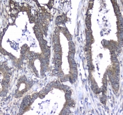 IHC testing of FFPE human colon cancer tissue with L1CAM antibody at 1ug/ml. Required HIER: steam section in pH6 citrate buffer for 20 min and allow to cool prior to staining.