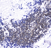IHC testing of FFPE human lung cancer tissue with L1CAM antibody at 1ug/ml. Required HIER: steam section in pH6 citrate buffer for 20 min and allow to cool prior to staining.