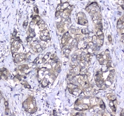 IHC testing of FFPE human breast cancer tissue with L1CAM antibody at 1ug/ml. Required HIER: steam section in pH6 citrate buffer for 20 min and allow to cool prior to staining.