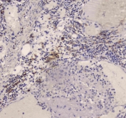 IHC testing of FFPE human intestinal cancer tissue with DC-SIGN antibody at 1ug/ml. Required HIER: steam section in pH6 citrate buffer for 20 min and allow to cool prior to staining.