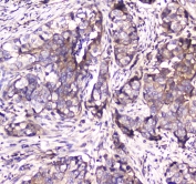 IHC testing of FFPE human breast cancer tissue with SDHB antibody at 1ug/ml. Required HIER: steam section in pH6 citrate buffer for 20 min and allow to cool prior to staining.