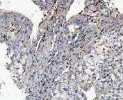 IHC staining of FFPE human liver cancer with CD16 antibody. HIER: boil tissue sections in pH8 EDTA for 20 min and allow to cool before testing.